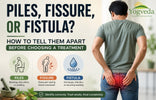 Piles, Fissure, or Fistula? How to Tell Them Apart Before Choosing a Treatment