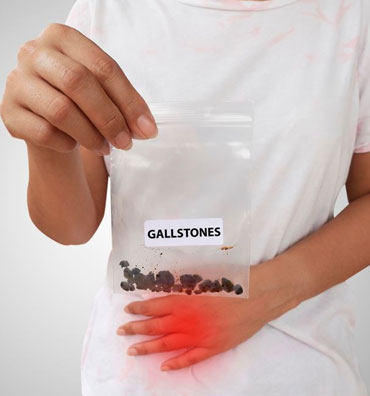 Gallbladder stone treatment in Ayurveda 