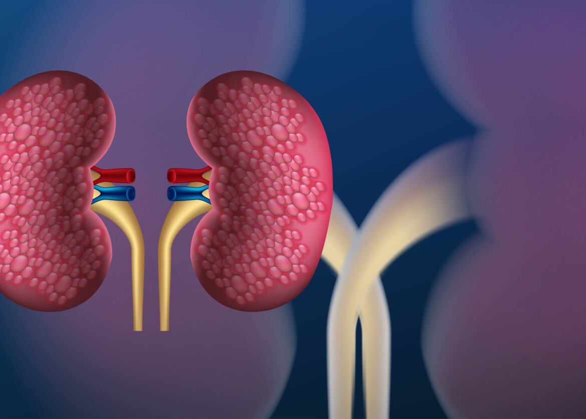 Kidney Stones Causes, Ayurvedic Treatment & Remedies