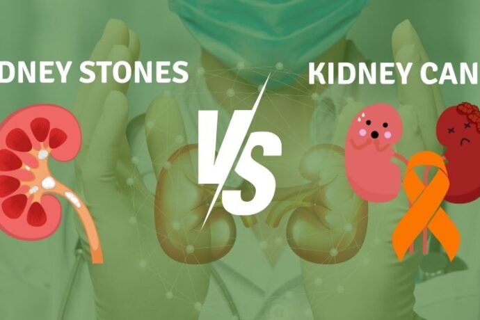 differences between kidney stones and kidney cancer